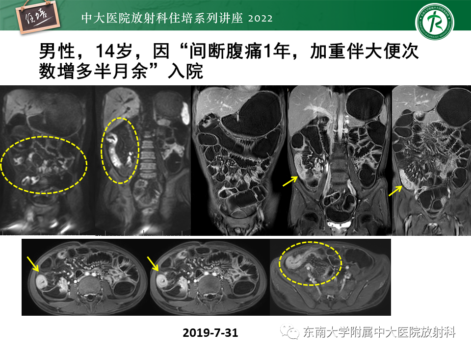影像PPT - 【PPT】从临床关注点出发——克罗恩病影像再认识-26