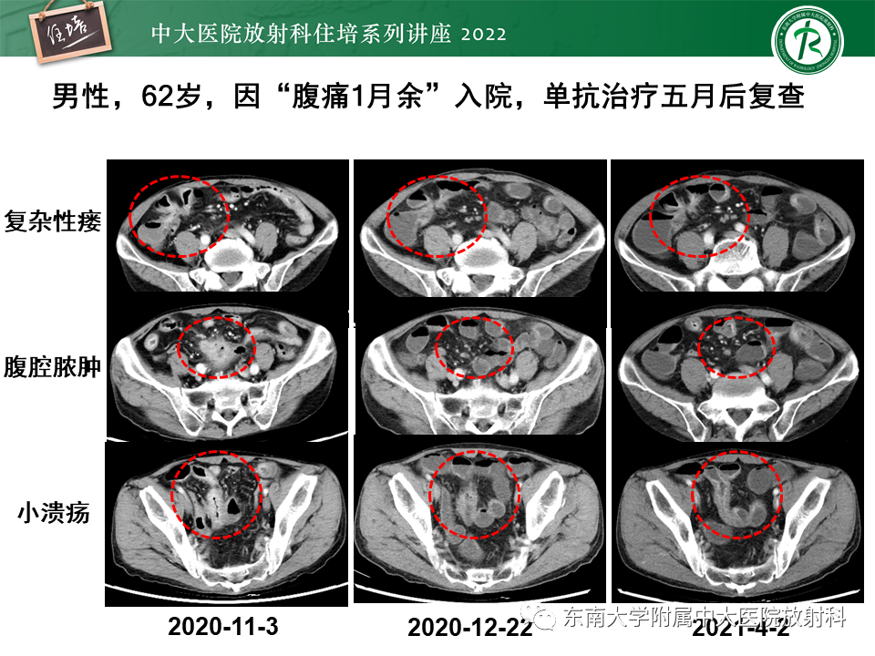 影像PPT - 【PPT】从临床关注点出发——克罗恩病影像再认识-41