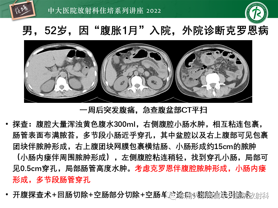 影像PPT - 【PPT】从临床关注点出发——克罗恩病影像再认识-54