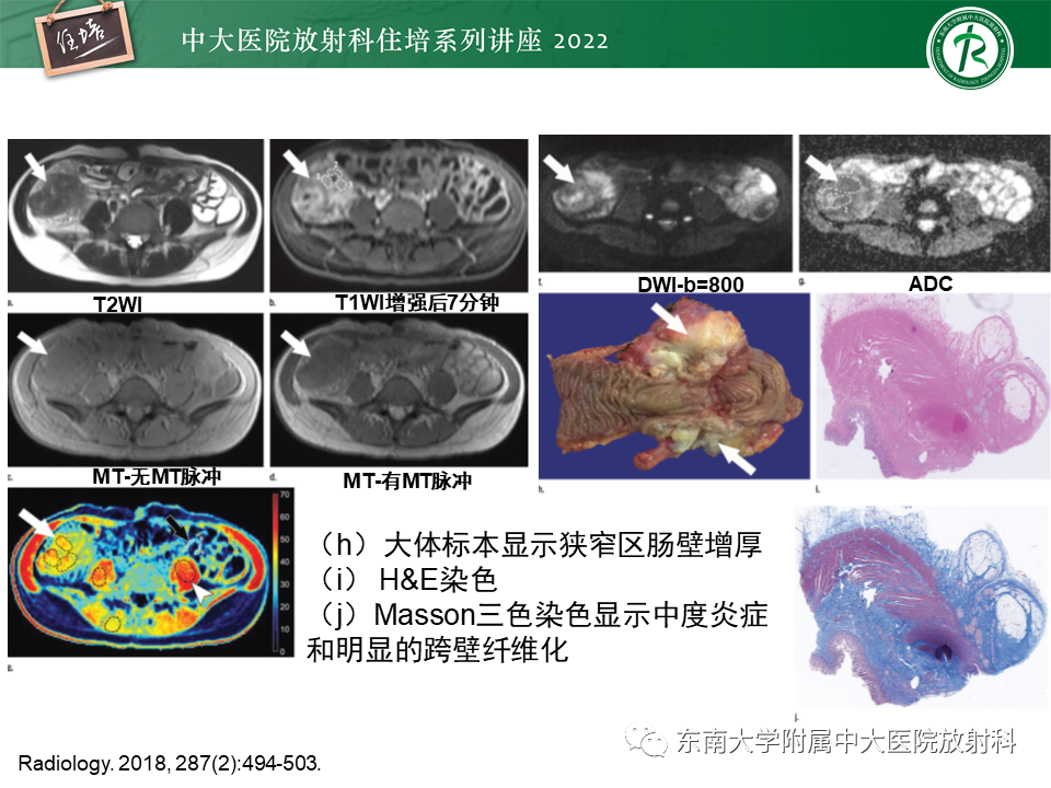 影像PPT - 【PPT】从临床关注点出发——克罗恩病影像再认识-29