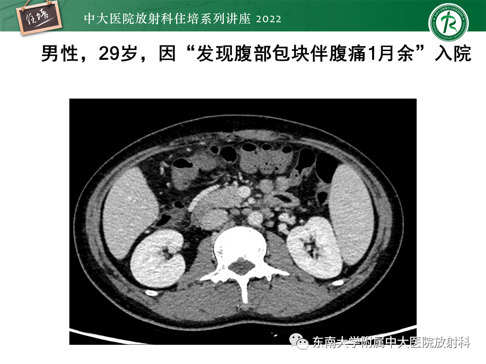影像PPT - 【PPT】从临床关注点出发——克罗恩病影像再认识-57