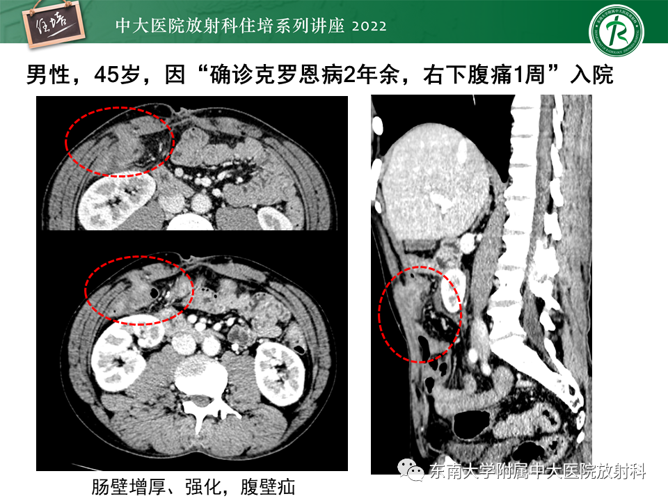 影像PPT - 【PPT】从临床关注点出发——克罗恩病影像再认识-38