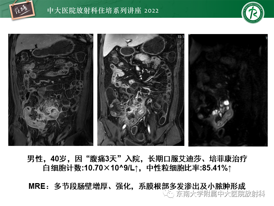 影像PPT - 【PPT】从临床关注点出发——克罗恩病影像再认识-33