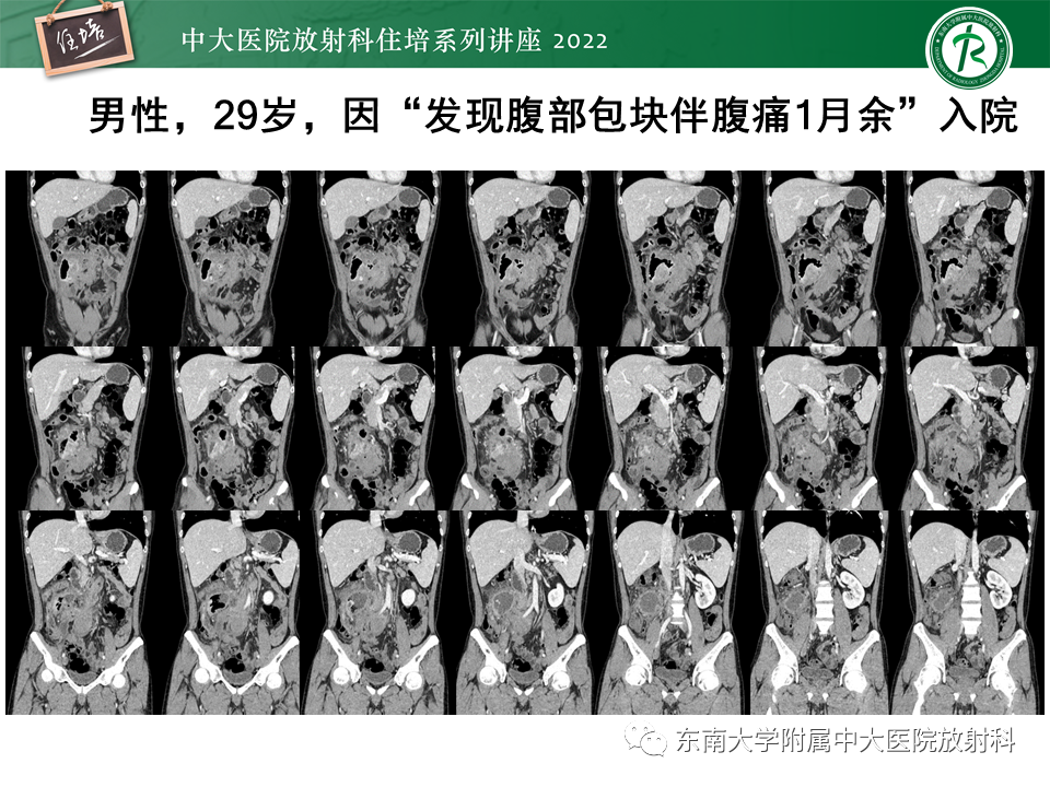 影像PPT - 【PPT】从临床关注点出发——克罗恩病影像再认识-58