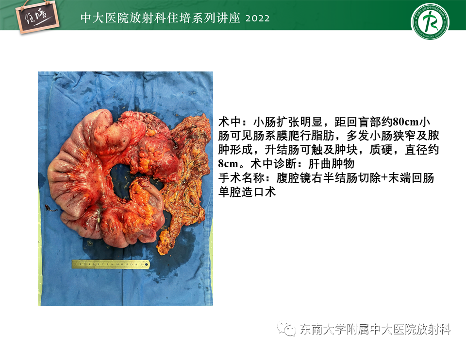 影像PPT - 【PPT】从临床关注点出发——克罗恩病影像再认识-51