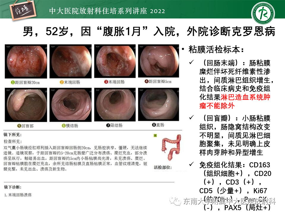 影像PPT - 【PPT】从临床关注点出发——克罗恩病影像再认识-53