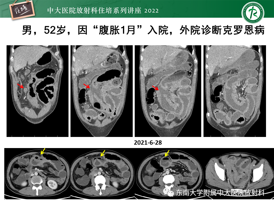 影像PPT - 【PPT】从临床关注点出发——克罗恩病影像再认识-52