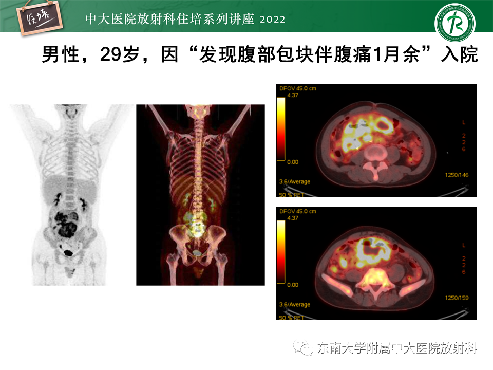 影像PPT - 【PPT】从临床关注点出发——克罗恩病影像再认识-60