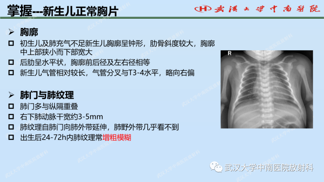 影像PPT - 【PPT】新生儿胸腹部常见疾病影像诊断-8