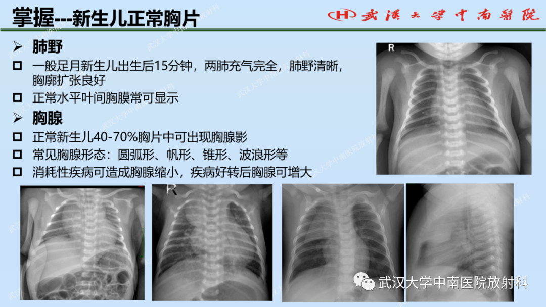 影像PPT - 【PPT】新生儿胸腹部常见疾病影像诊断-9