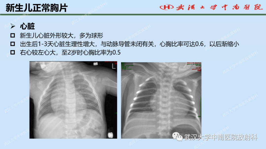 影像PPT - 【PPT】新生儿胸腹部常见疾病影像诊断-10
