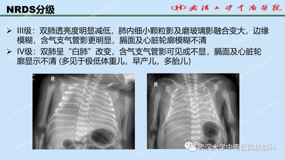 影像PPT - 【PPT】新生儿胸腹部常见疾病影像诊断-14