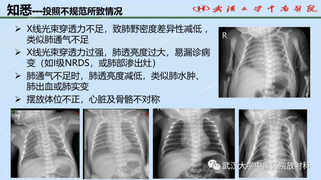 影像PPT - 【PPT】新生儿胸腹部常见疾病影像诊断-6