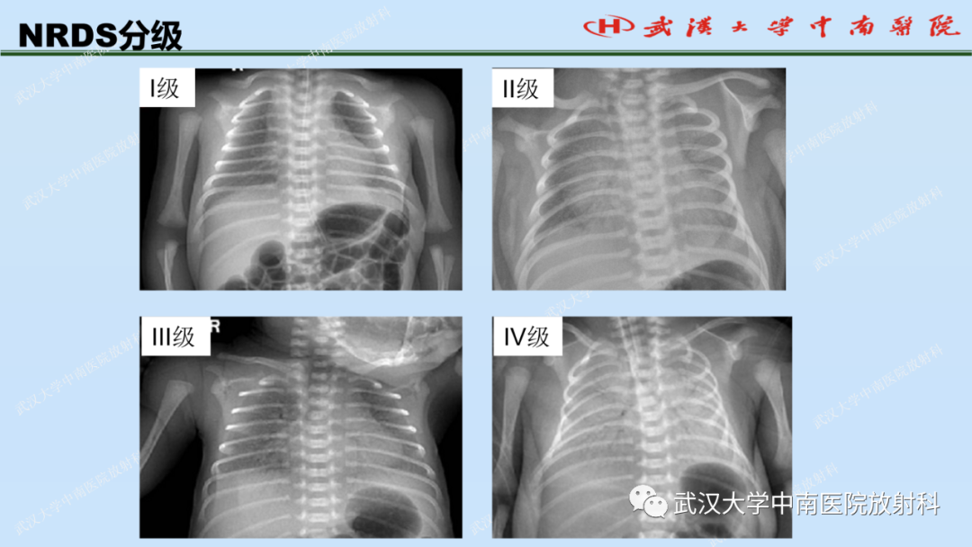 影像PPT - 【PPT】新生儿胸腹部常见疾病影像诊断-16