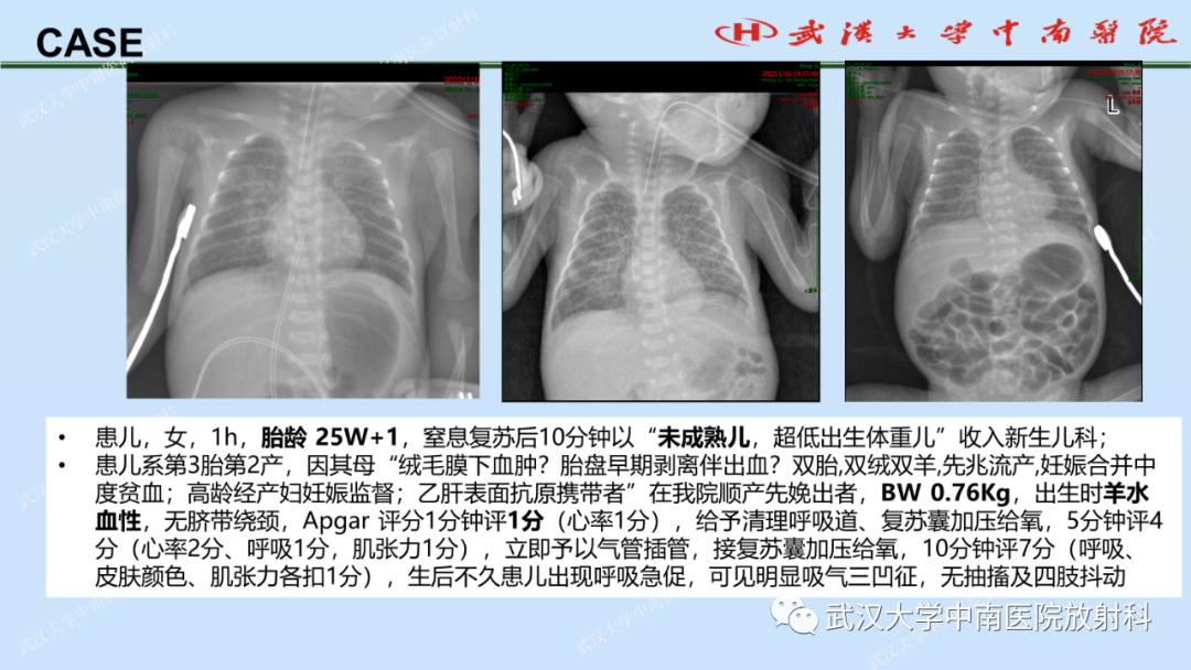影像PPT - 【PPT】新生儿胸腹部常见疾病影像诊断-17