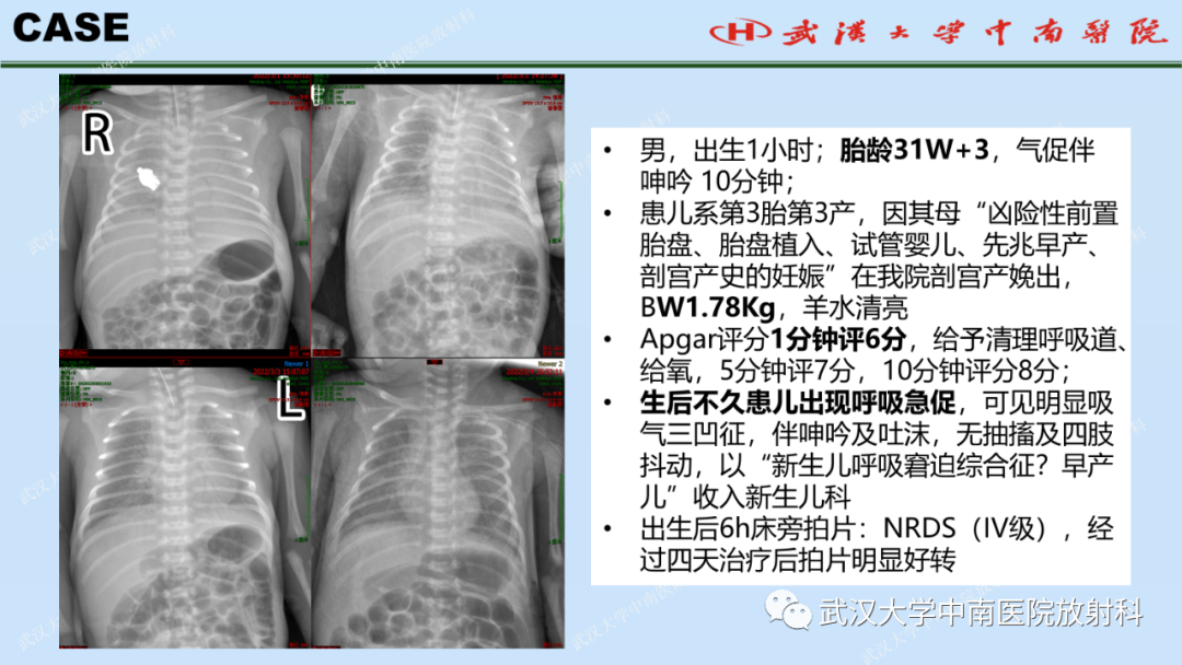 影像PPT - 【PPT】新生儿胸腹部常见疾病影像诊断-18