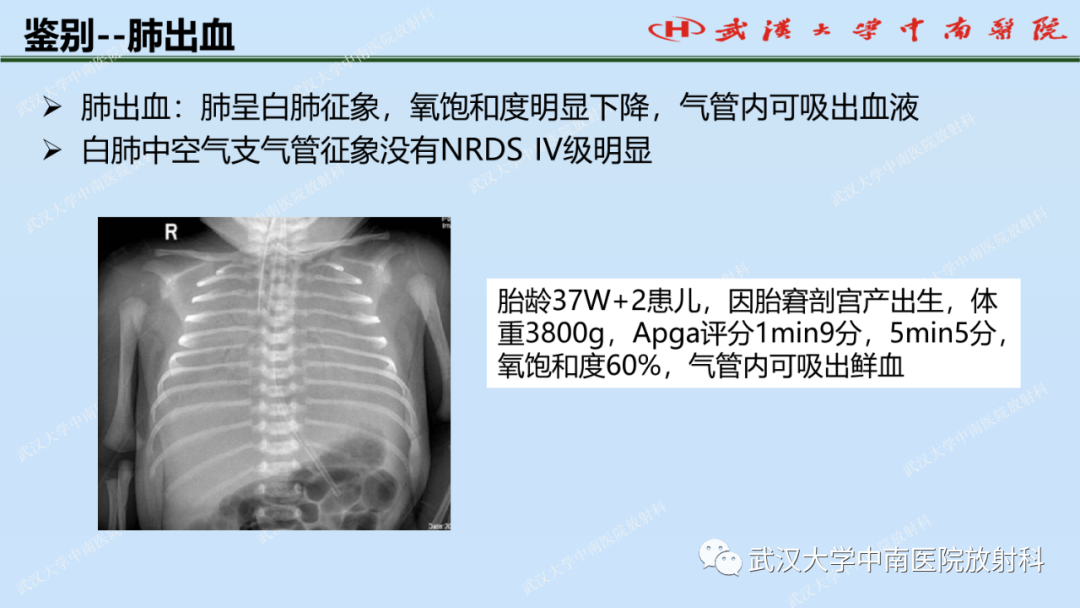 影像PPT - 【PPT】新生儿胸腹部常见疾病影像诊断-19
