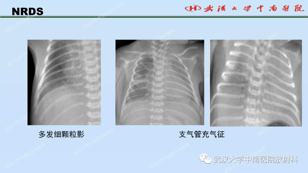 影像PPT - 【PPT】新生儿胸腹部常见疾病影像诊断-15