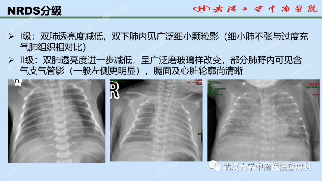 影像PPT - 【PPT】新生儿胸腹部常见疾病影像诊断-13