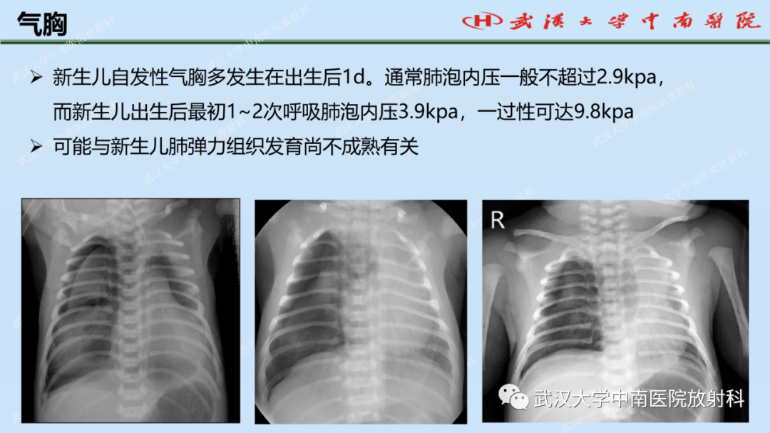 影像PPT - 【PPT】新生儿胸腹部常见疾病影像诊断-24