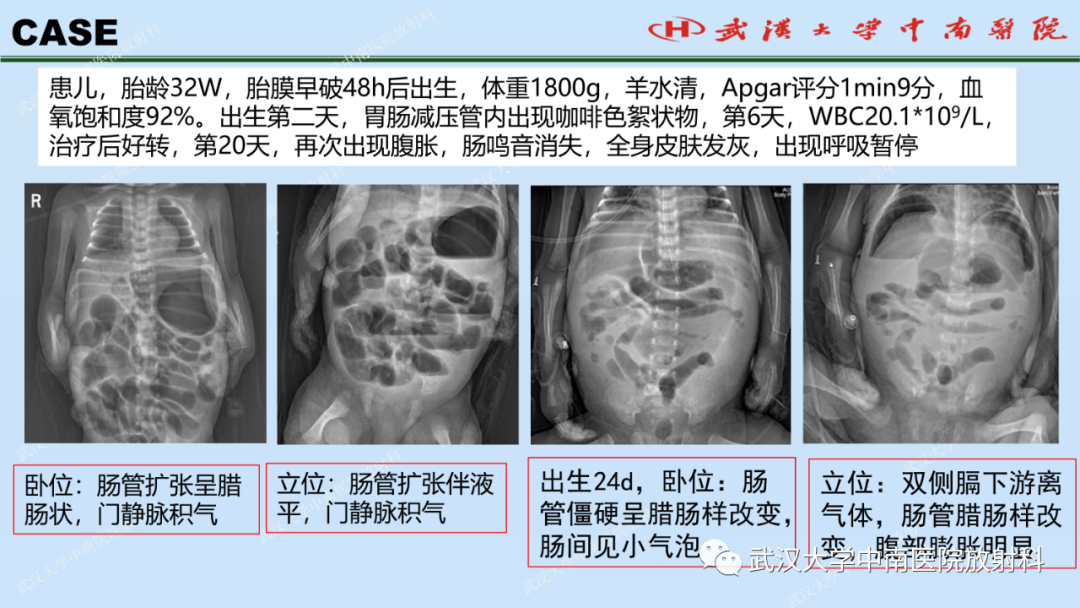 影像PPT - 【PPT】新生儿胸腹部常见疾病影像诊断-30