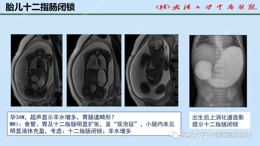 影像PPT - 【PPT】新生儿胸腹部常见疾病影像诊断-34