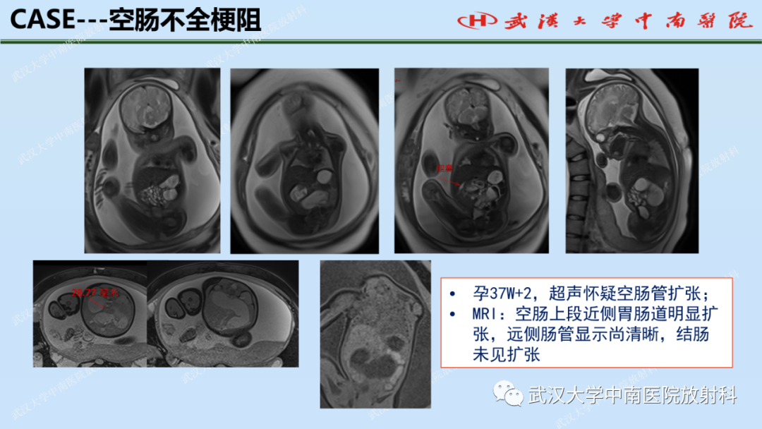影像PPT - 【PPT】新生儿胸腹部常见疾病影像诊断-35