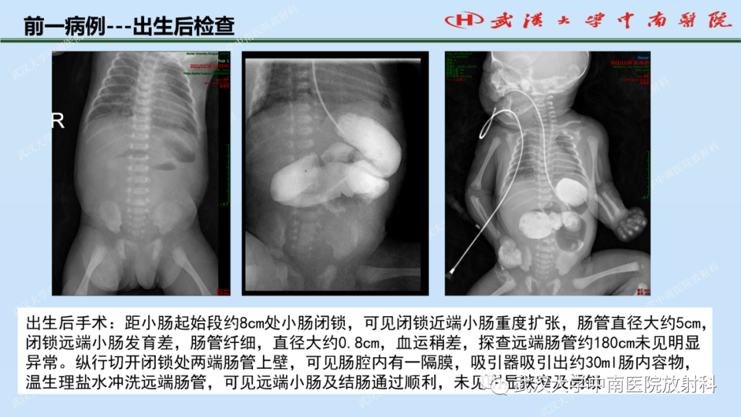 影像PPT - 【PPT】新生儿胸腹部常见疾病影像诊断-36
