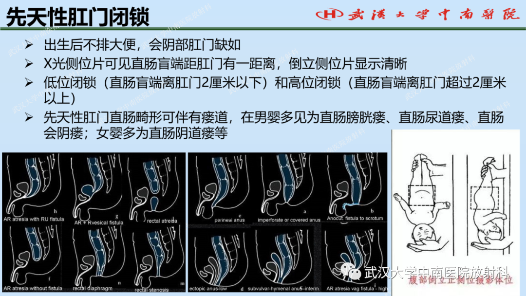 影像PPT - 【PPT】新生儿胸腹部常见疾病影像诊断-37