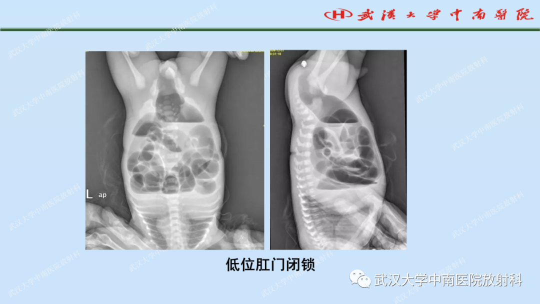影像PPT - 【PPT】新生儿胸腹部常见疾病影像诊断-39