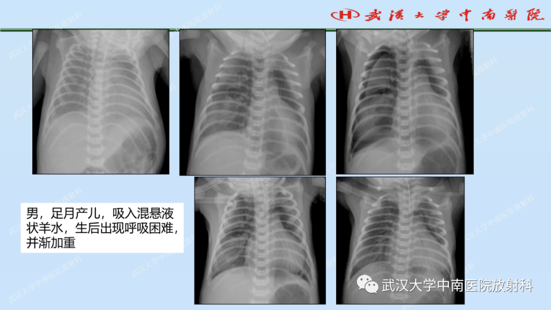 影像PPT - 【PPT】新生儿胸腹部常见疾病影像诊断-21