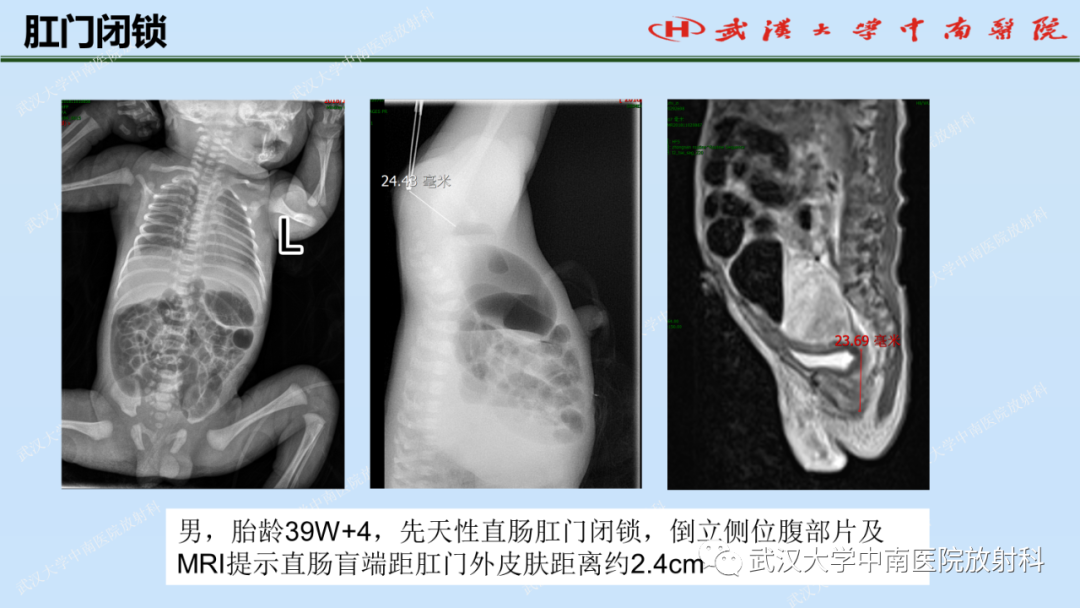 影像PPT - 【PPT】新生儿胸腹部常见疾病影像诊断-38