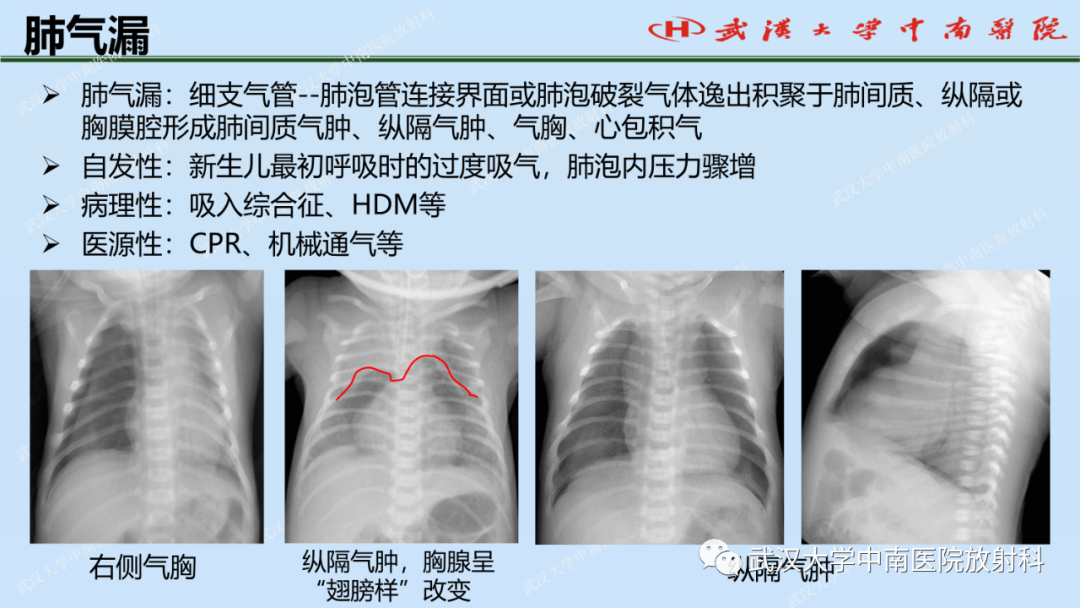 影像PPT - 【PPT】新生儿胸腹部常见疾病影像诊断-22