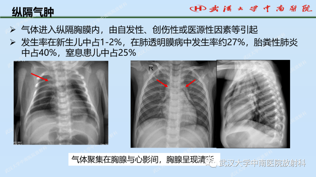 影像PPT - 【PPT】新生儿胸腹部常见疾病影像诊断-23