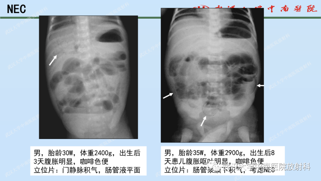 影像PPT - 【PPT】新生儿胸腹部常见疾病影像诊断-29
