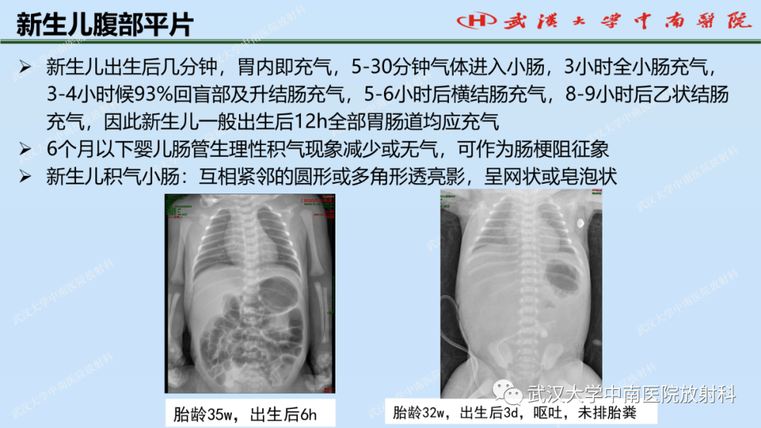 影像PPT - 【PPT】新生儿胸腹部常见疾病影像诊断-27