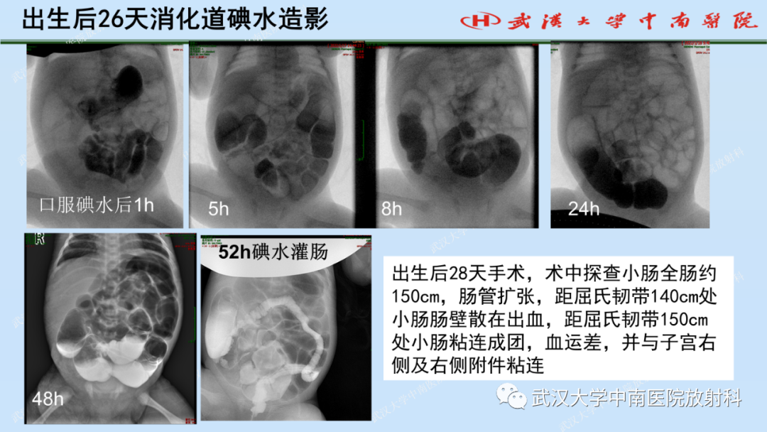 影像PPT - 【PPT】新生儿胸腹部常见疾病影像诊断-32