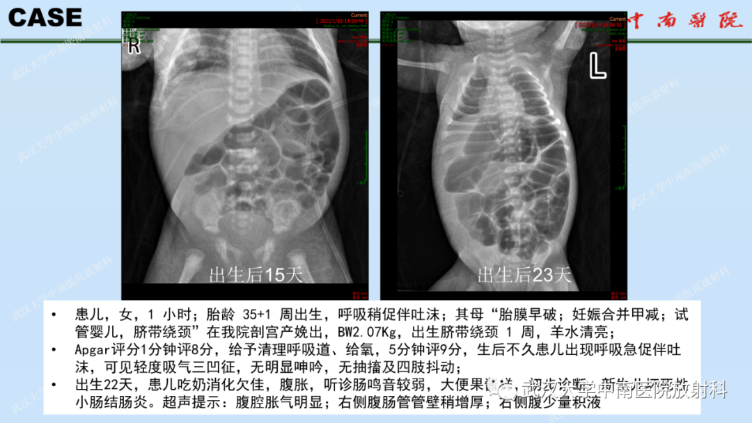 影像PPT - 【PPT】新生儿胸腹部常见疾病影像诊断-31