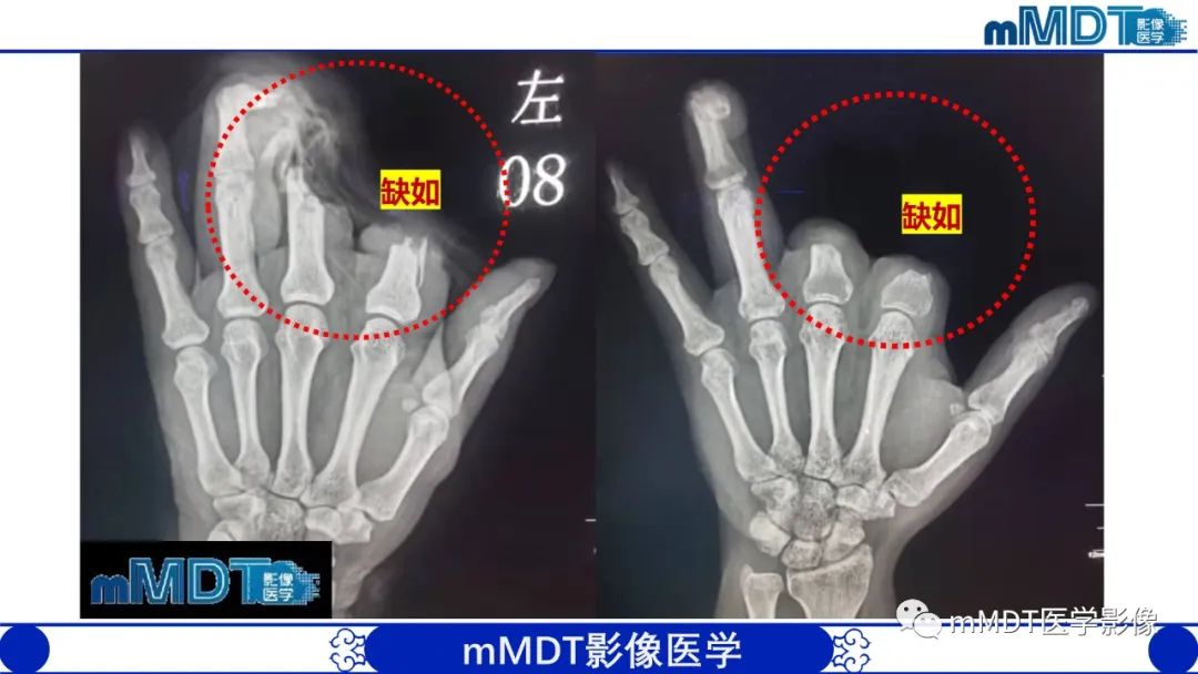 影像PPT - 【PPT】四肢短骨末端“消失”迷影追踪-4 影像PPT - 【PPT】四肢短骨末端“消失”迷影追踪-4