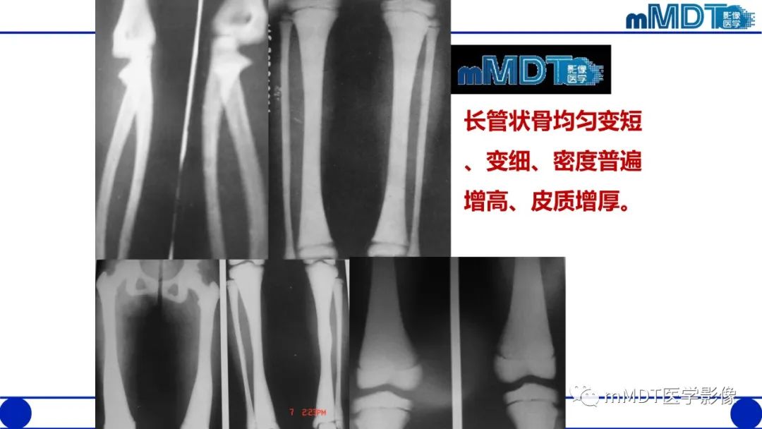 影像PPT - 【PPT】四肢短骨末端“消失”迷影追踪-11 影像PPT - 【PPT】四肢短骨末端“消失”迷影追踪-11