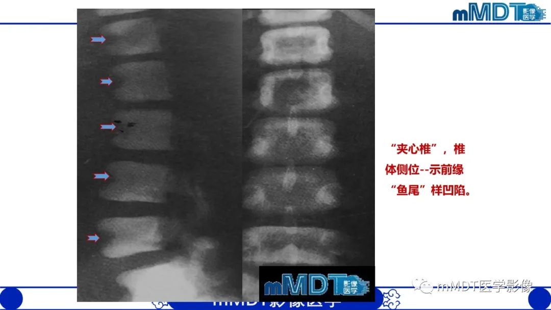 影像PPT - 【PPT】四肢短骨末端“消失”迷影追踪-12 影像PPT - 【PPT】四肢短骨末端“消失”迷影追踪-12
