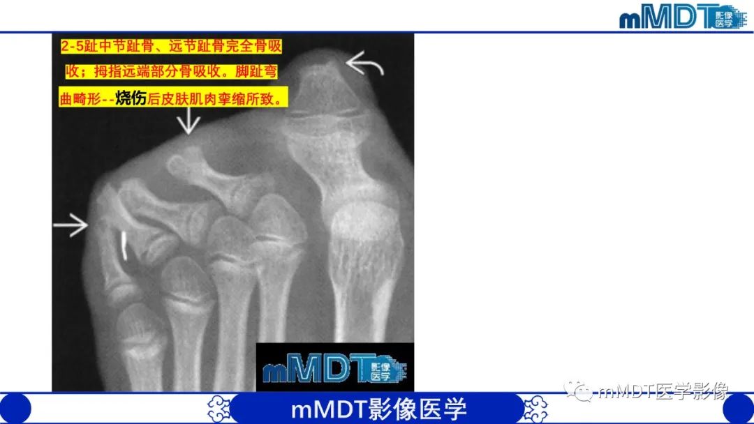 影像PPT - 【PPT】四肢短骨末端“消失”迷影追踪-8 影像PPT - 【PPT】四肢短骨末端“消失”迷影追踪-8