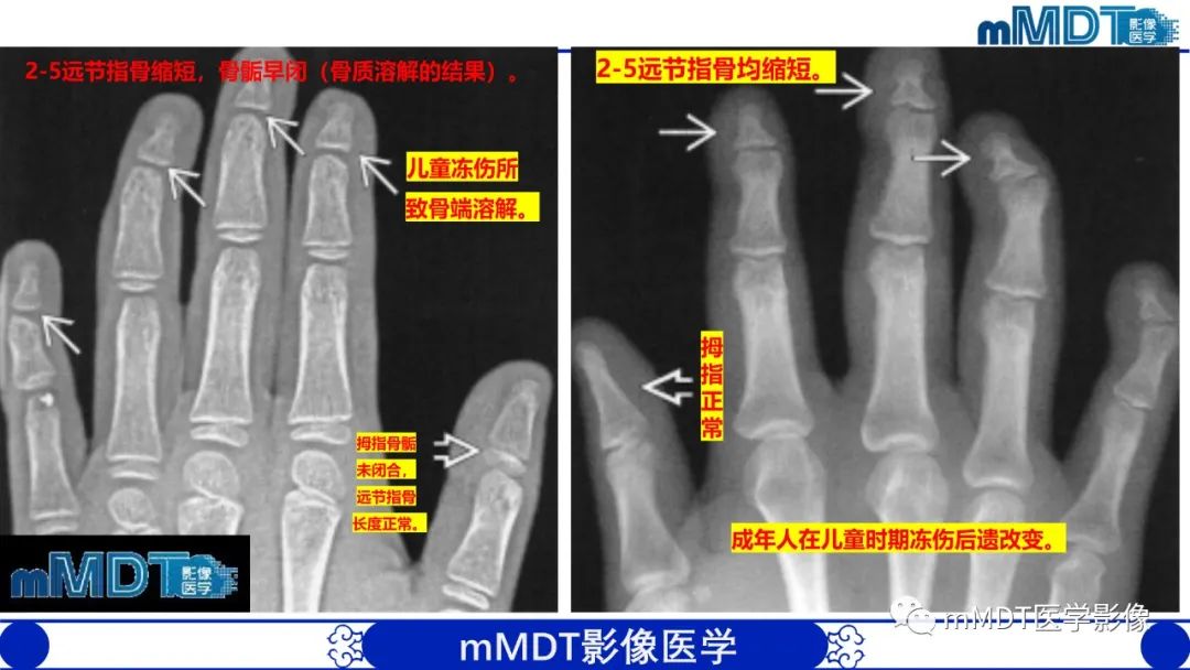 影像PPT - 【PPT】四肢短骨末端“消失”迷影追踪-6 影像PPT - 【PPT】四肢短骨末端“消失”迷影追踪-6