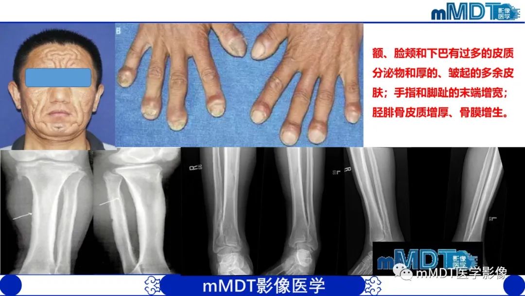 影像PPT - 【PPT】四肢短骨末端“消失”迷影追踪-15 影像PPT - 【PPT】四肢短骨末端“消失”迷影追踪-15