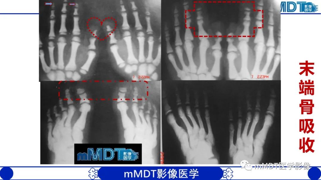 影像PPT - 【PPT】四肢短骨末端“消失”迷影追踪-13 影像PPT - 【PPT】四肢短骨末端“消失”迷影追踪-13