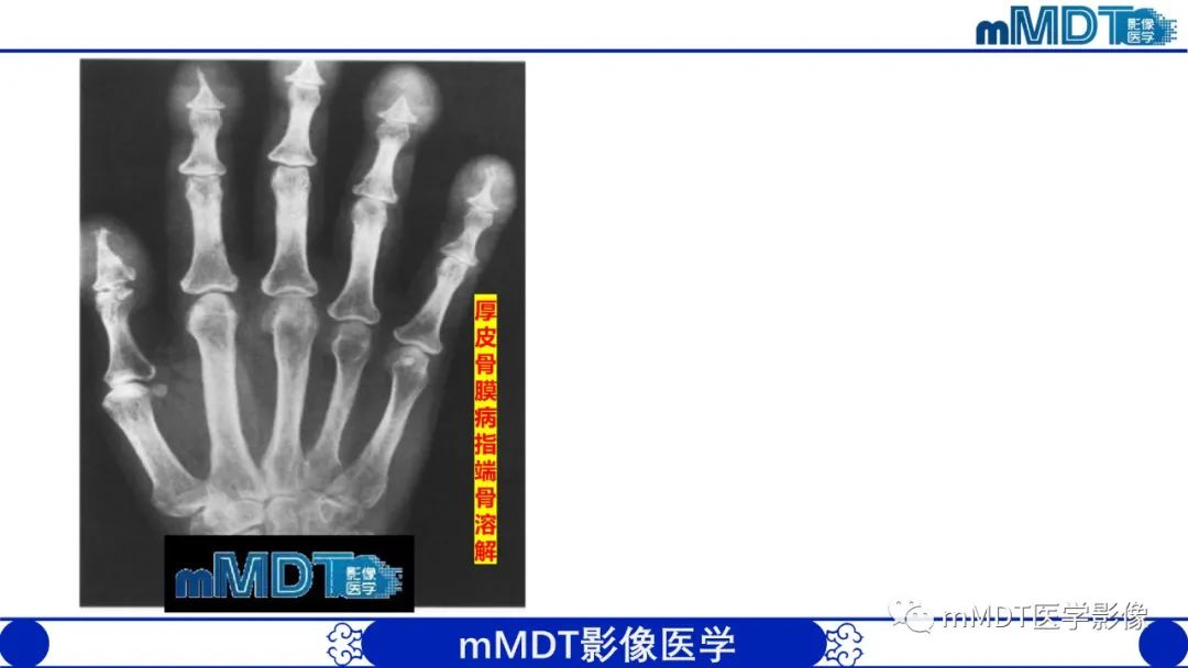 影像PPT - 【PPT】四肢短骨末端“消失”迷影追踪-17 影像PPT - 【PPT】四肢短骨末端“消失”迷影追踪-17