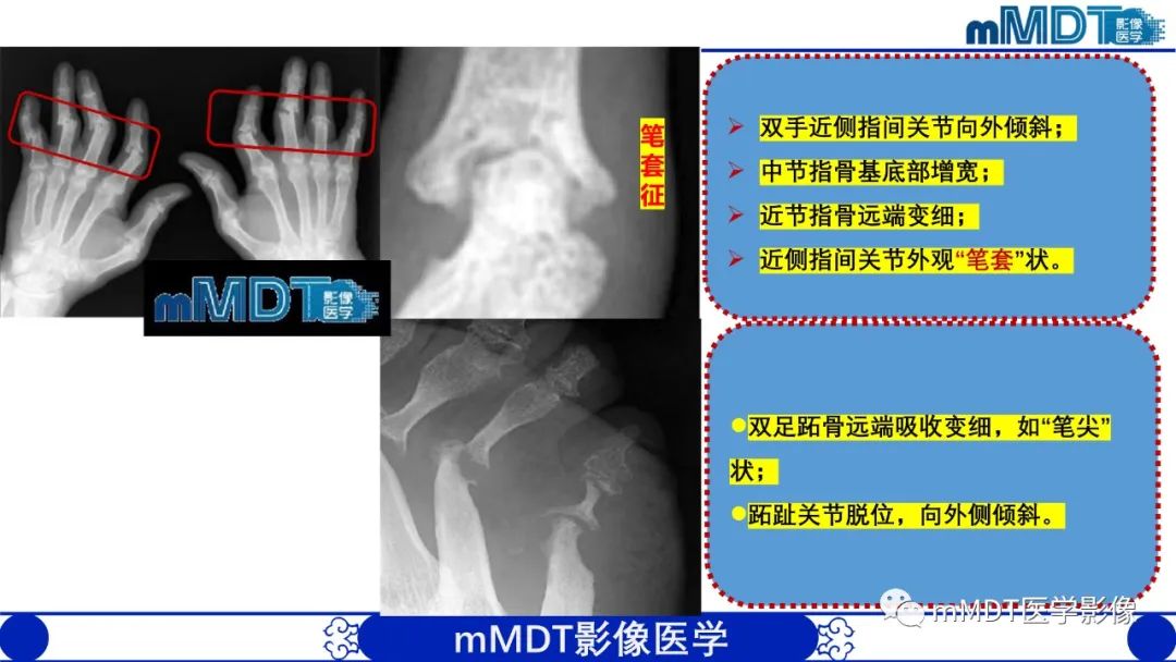 影像PPT - 【PPT】四肢短骨末端“消失”迷影追踪-23 影像PPT - 【PPT】四肢短骨末端“消失”迷影追踪-23