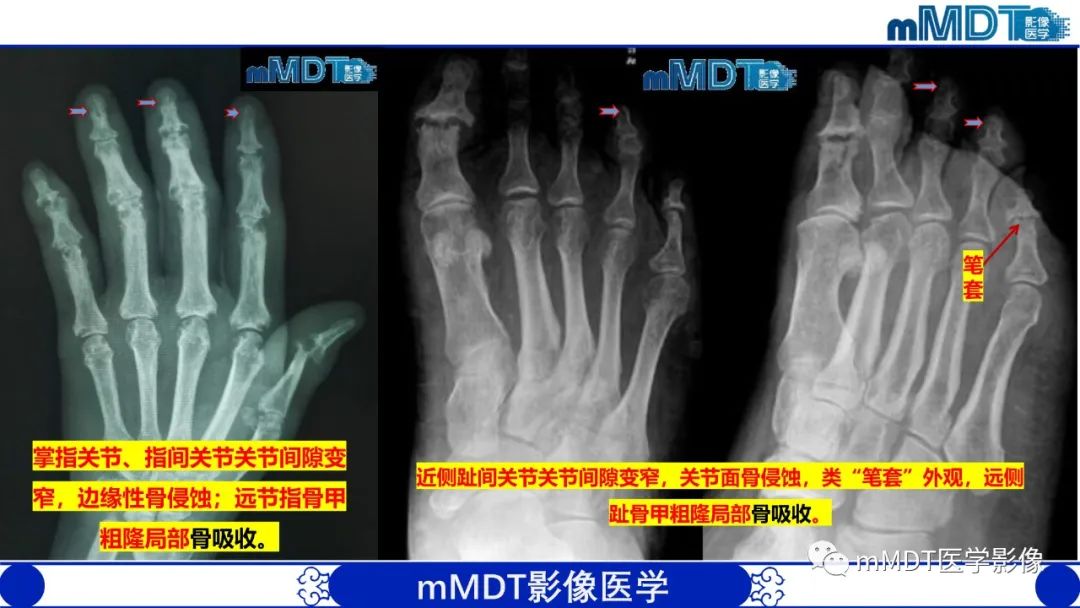 影像PPT - 【PPT】四肢短骨末端“消失”迷影追踪-24 影像PPT - 【PPT】四肢短骨末端“消失”迷影追踪-24