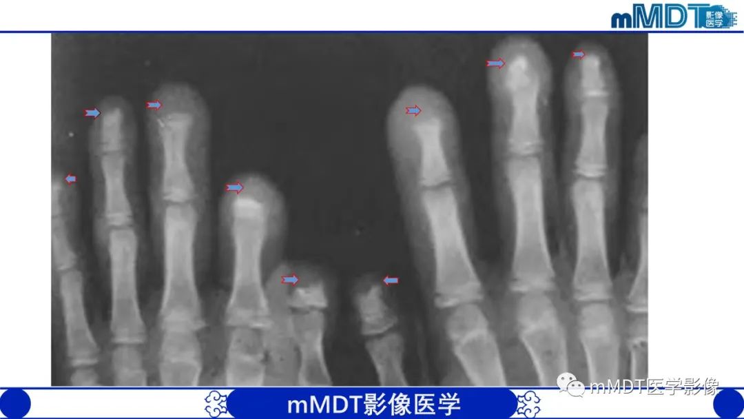 影像PPT - 【PPT】四肢短骨末端“消失”迷影追踪-20 影像PPT - 【PPT】四肢短骨末端“消失”迷影追踪-20
