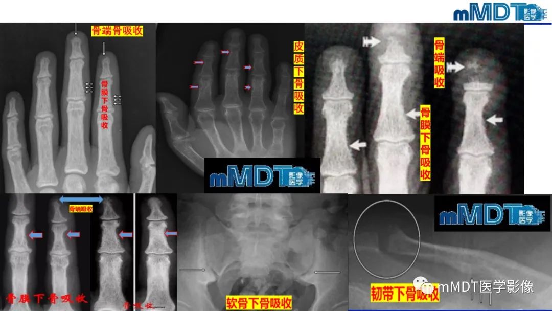 影像PPT - 【PPT】四肢短骨末端“消失”迷影追踪-29 影像PPT - 【PPT】四肢短骨末端“消失”迷影追踪-29